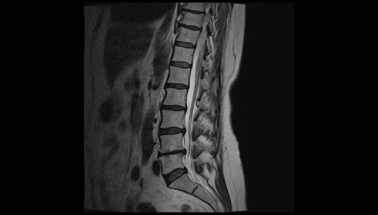 Diagnos vu Réckschmerzen an der Lendegéigend