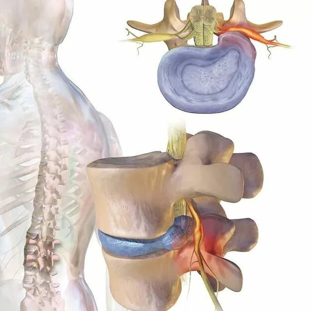 intervertebral disc Problemer