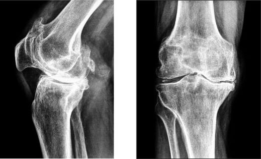 Gonarthrose vum Knéi op Röntgen