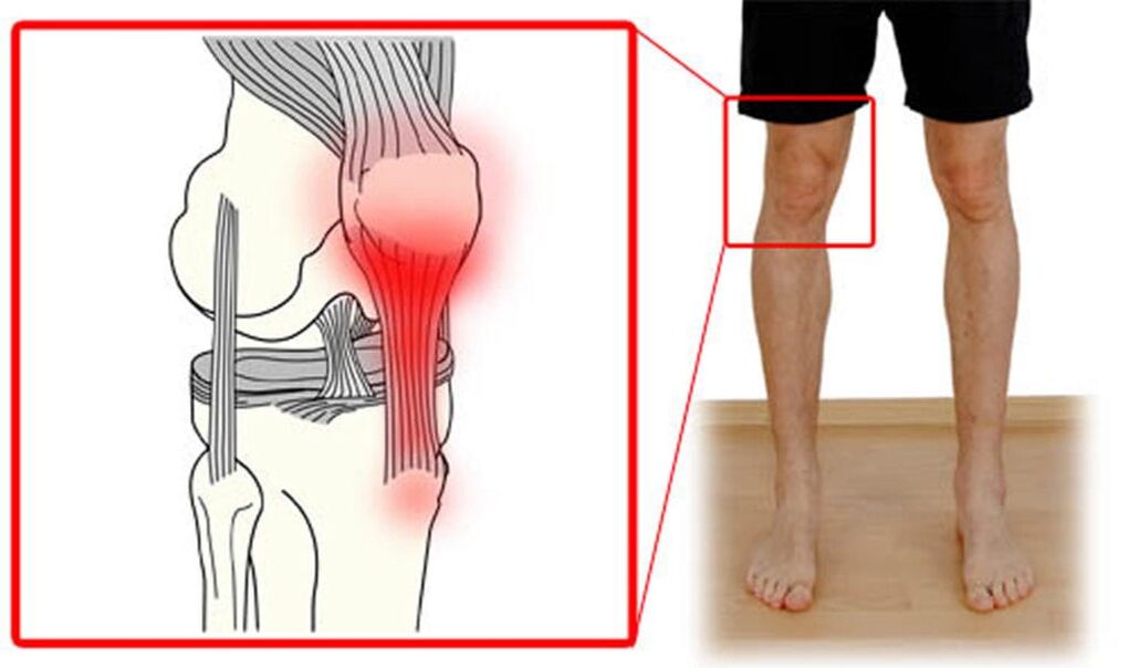 Tendinitis - Entzündung vun de Sehnen am Kniegelenk