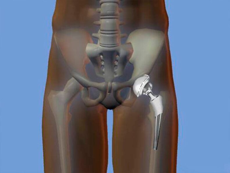 Hip arthroplasty fir Péng