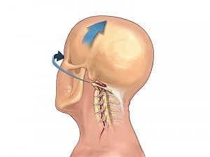 wéi Osteochondrose vun der Halswirbelsail manifestéiert sech