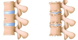 wéi een d'Präsenz vun der Osteochondrose vun der Lendenwirbelsäule erkennt