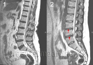 Osteochondrose der Wirbelsäule