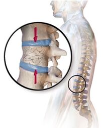 Osteoporose provozéiert Schmerz zréck an der Lendenbereich