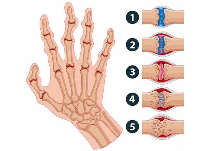 Stadien vun der Entwécklung vun Arthritis vun de Gelenke vun de Fanger